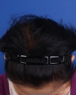 After Hair Transplant&nbsp;Hair Thinning